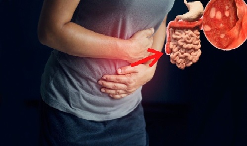 gastroenterologo mexicali especialista en colitis