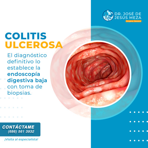 colitis ulcerosa curacion definitiva