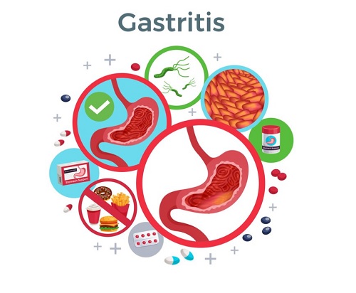 5 consejos sobre cómo prevenir la gastritis